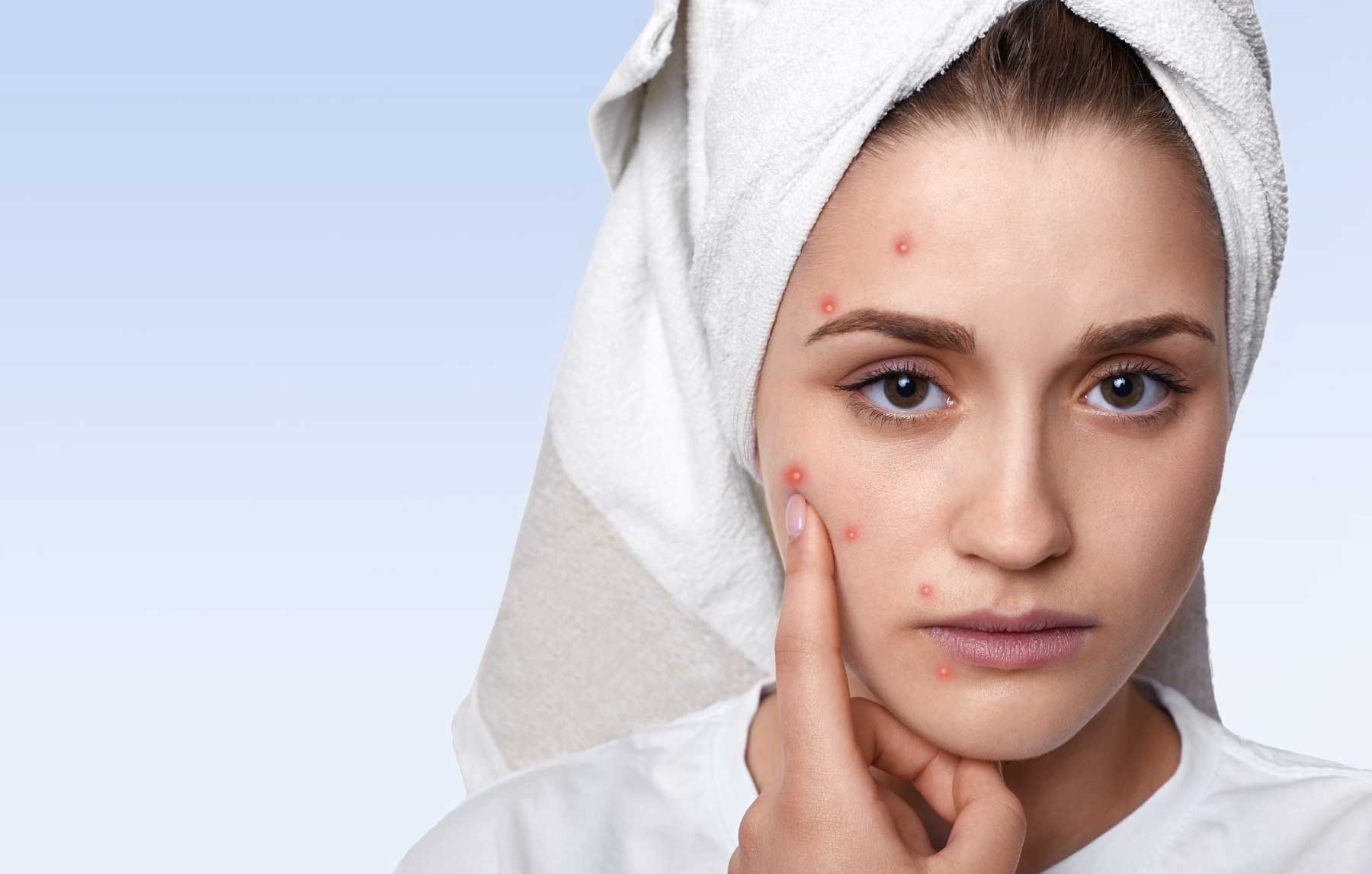 10 Powerful Home Remedies For Acne