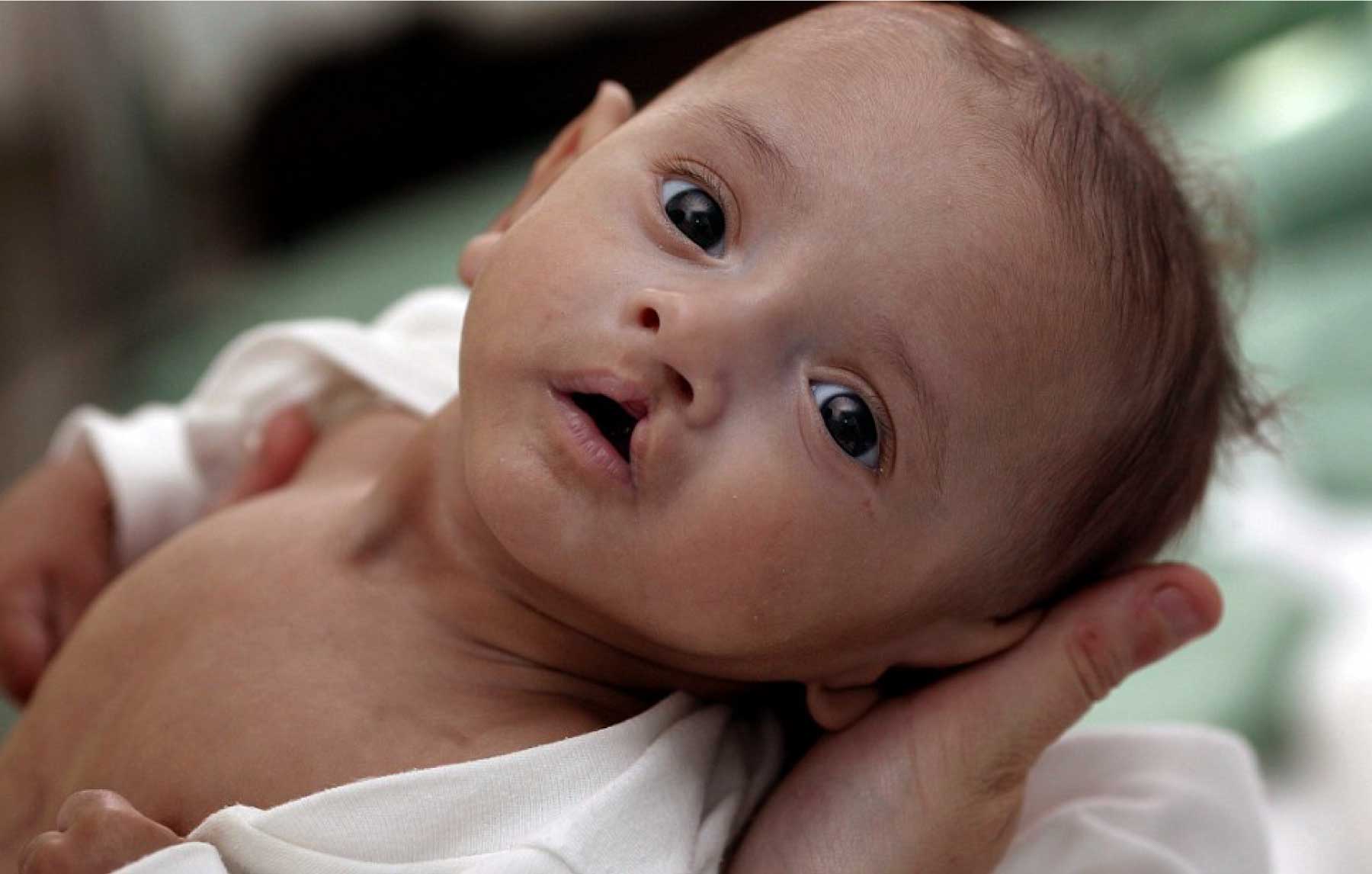 Cleft Lip In Babies: Things You Have To Know?
