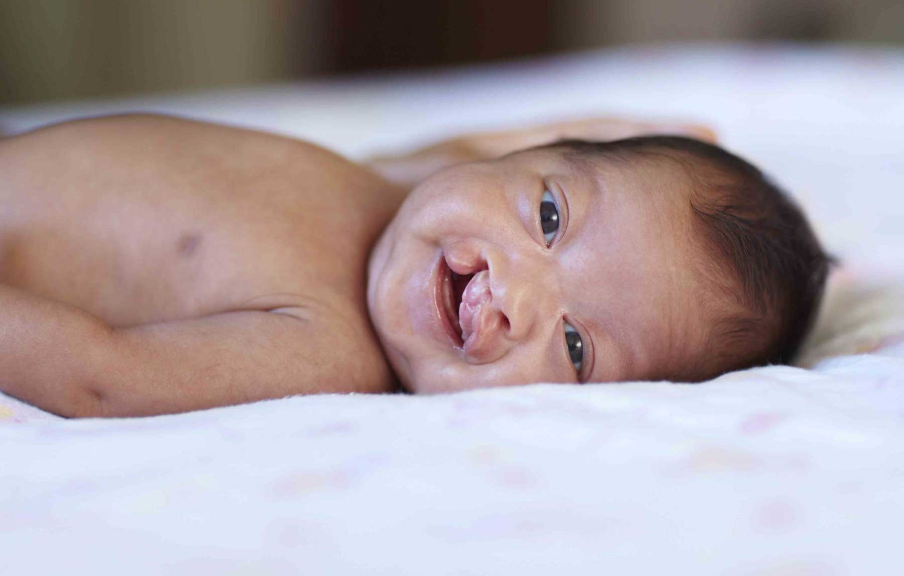 Cleft Palate In Babies