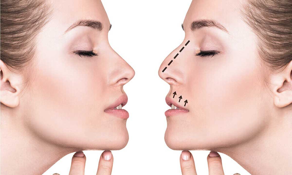 Rhinoplasty: Causes, Preparation, Procedure And Recovery