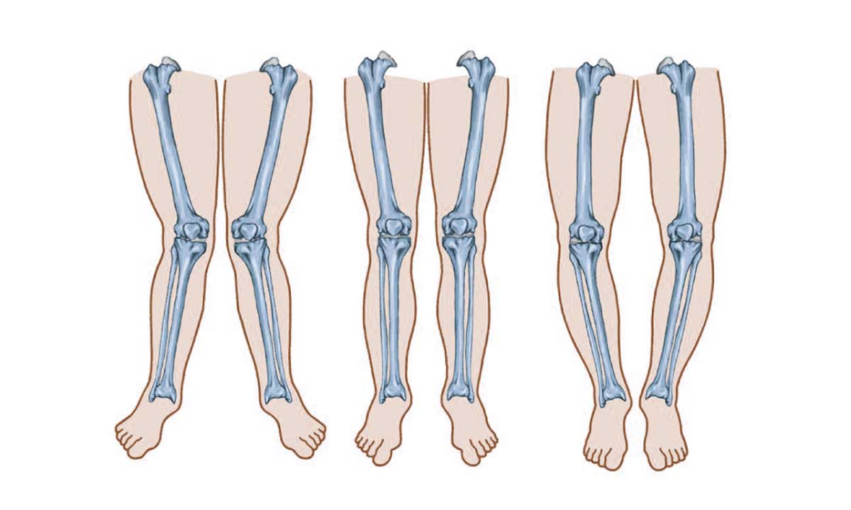 What We Need To Know About Knock Knees{Genu Valgum}?