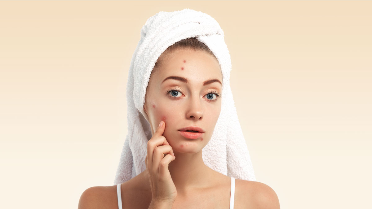 5 Home Remedies For Dark Spots And Pimple Marks