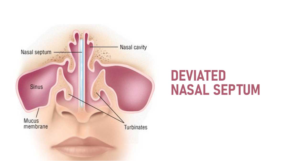 Deviated Nasal Septum: Causes, Symptoms, Diagnosis And Treatment