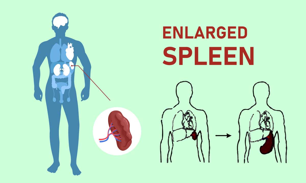 Splenomegaly[Enlarged Spleen]: Do you Know About It !