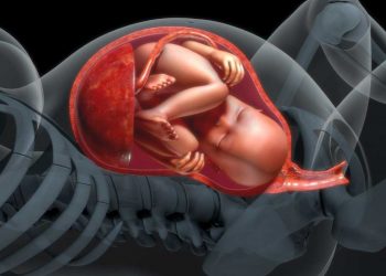 Polyhydraminos : high amniotic fluid levels ,borderline high amniotic fluid